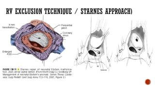RV EXCLUSION TECHNIQUE / STARNES APPROACH)
 