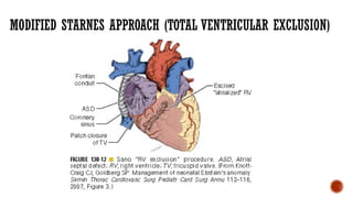 MODIFIED STARNES APPROACH (TOTAL VENTRICULAR EXCLUSION)
 