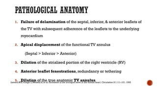 PATHOLOGICAL ANATOMY
1. Failure of delamination of the septal, inferior, & anterior leaflets of
the TV with subsequent adherence of the leaflets to the underlying
myocardium
2. Apical displacement of the functional TV annulus
(Septal > Inferior > Anterior)
3. Dilation of the atrialised portion of the right ventricle (RV)
4. Anterior leaflet fenestrations, redundancy or tethering
5. Dilation of the true anatomic TV annulus
LamersWH,Viragh S,Wessels A,et al: Formation of the tricuspid valve in the human heart.Circulation 91:111–121,1995.
 