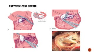 ANATOMIC CONE REPAIR
 