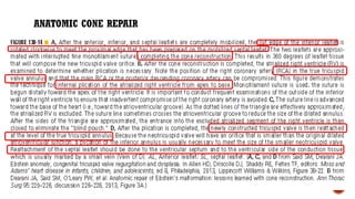 ANATOMIC CONE REPAIR
 