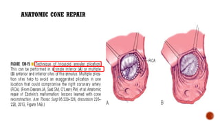 ANATOMIC CONE REPAIR
 