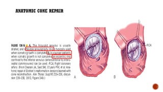 ANATOMIC CONE REPAIR
 
