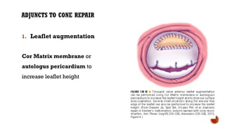 ADJUNCTS TO CONE REPAIR
1. Leaflet augmentation
Cor Matrix membrane or
autologus pericardium to
increase leaflet height
 