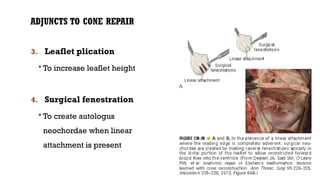 ADJUNCTS TO CONE REPAIR
3. Leaflet plication
 To increase leaflet height
4. Surgical fenestration
 To create autologus
neochordae when linear
attachment is present
 
