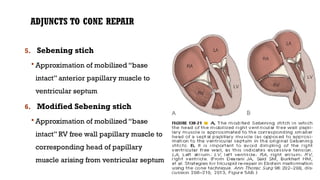 ADJUNCTS TO CONE REPAIR
5. Sebening stich
 Approximation of mobilized “base
intact” anterior papillary muscle to
ventricular septum
6. Modified Sebening stich
 Approximation of mobilized “base
intact” RV free wall papillary muscle to
corresponding head of papillary
muscle arising from ventricular septum
 
