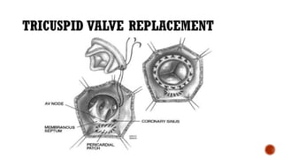 TRICUSPID VALVE REPLACEMENT
 