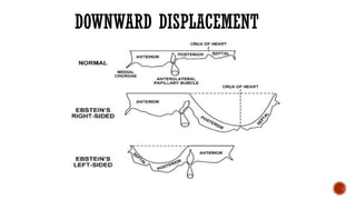 DOWNWARD DISPLACEMENT
 
