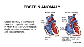 Comprehensive Overview of Ebstein Anomaly: Diagnosis, Pathology, and ...