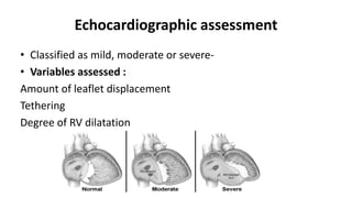 Echocardiographic assessment
• Classified as mild, moderate or severe-
• Variables assessed :
Amount of leaflet displacement
Tethering
Degree of RV dilatation
 