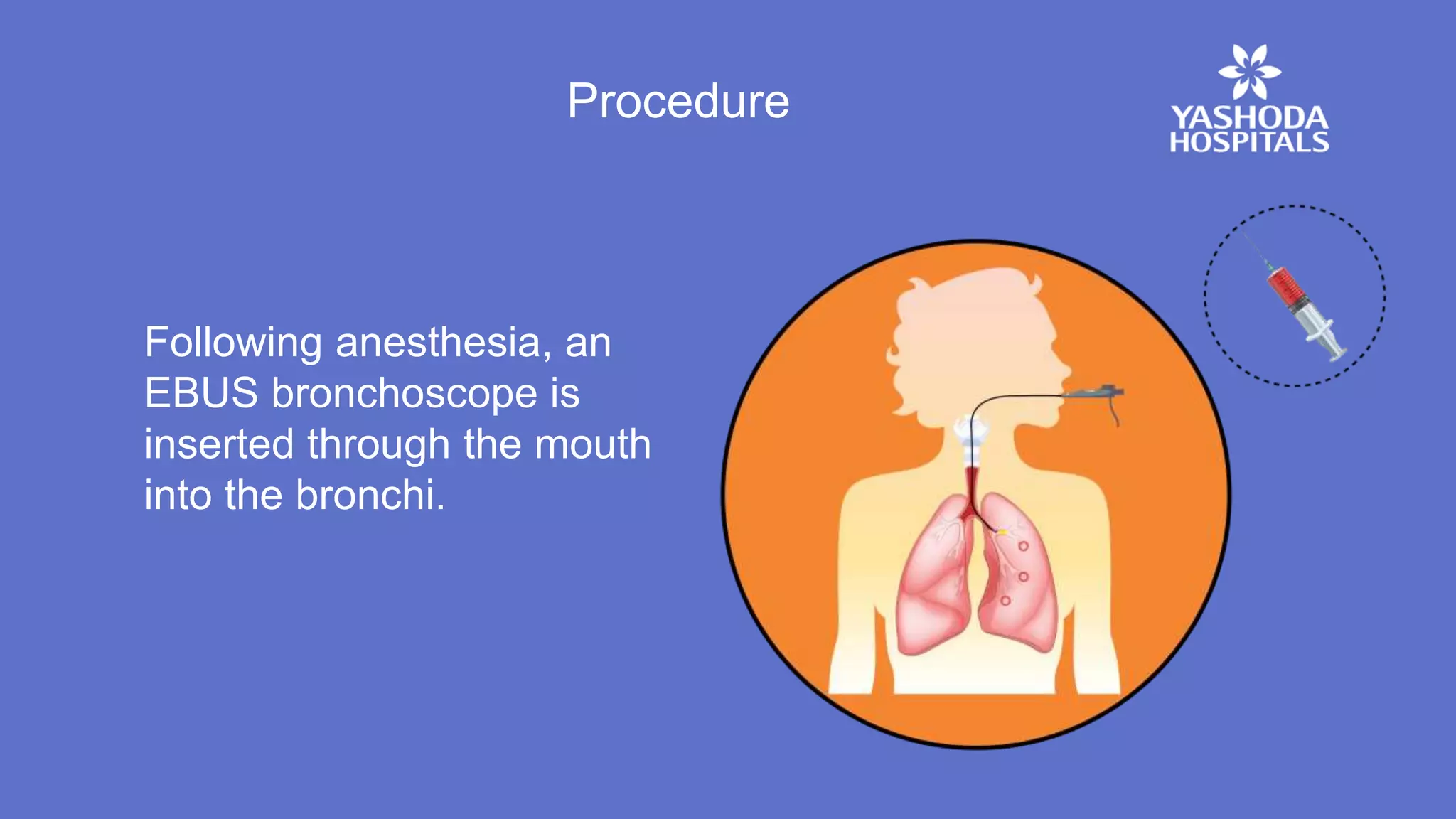 Procedure
Following anesthesia, an
EBUS bronchoscope is
inserted through the mouth
into the bronchi.