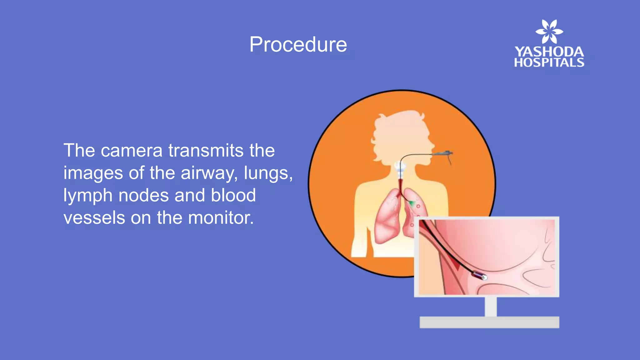 Procedure
The camera transmits the
images of the airway, lungs,
lymph nodes and blood
vessels on the monitor.