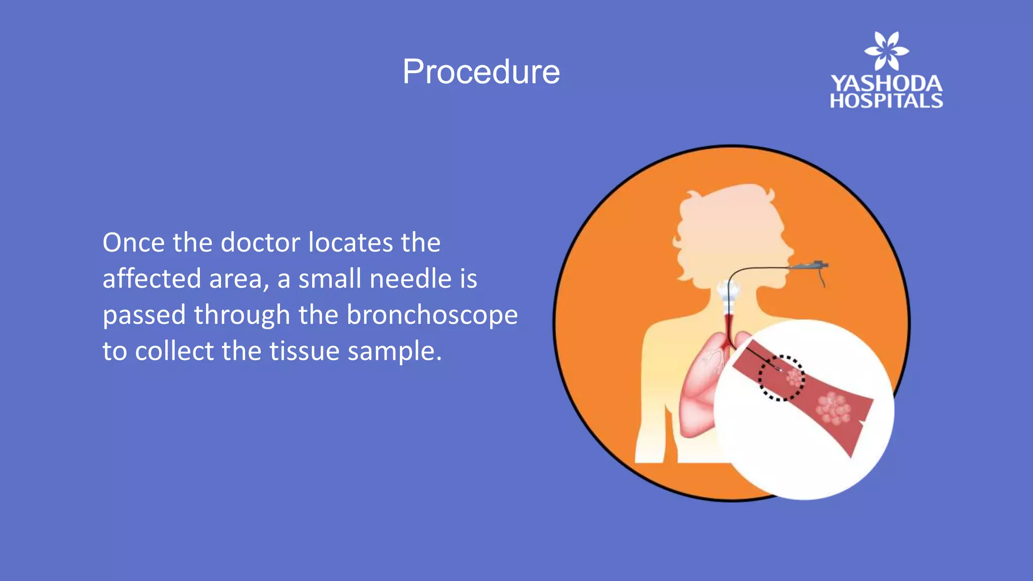 Procedure
Once the doctor locates the
affected area, a small needle is
passed through the bronchoscope
to collect the tissue sample.