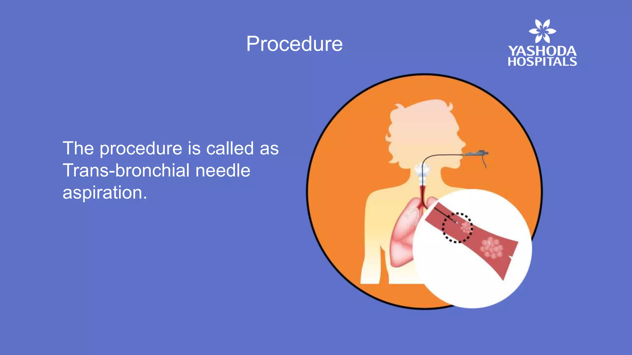 Procedure
The procedure is called as
Trans-bronchial needle
aspiration.
