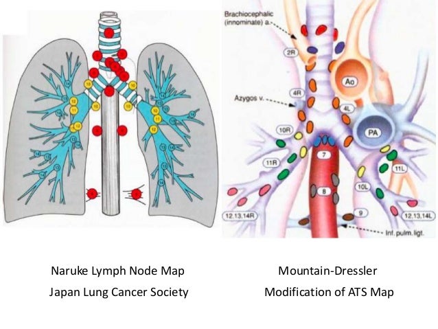 Endobronchial Ultrasound Guidance of TBNA. Current Approach To Lung C…