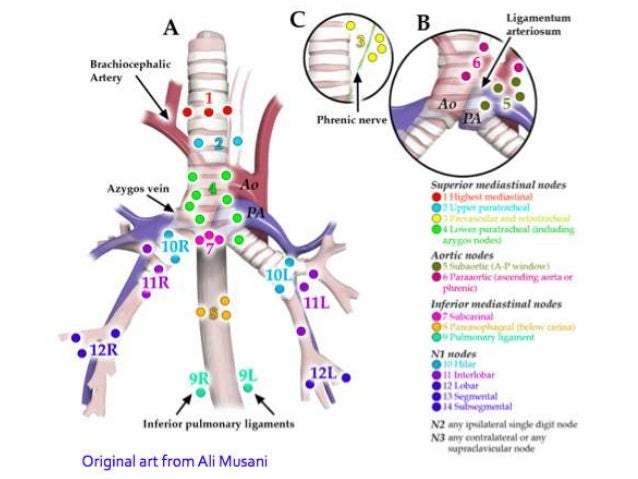 Endobronchial Ultrasound Guidance of TBNA. Current Approach To Lung C…