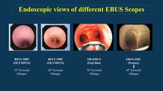 ENDO BRONCHEAL ULTRASONOGRAPHY (EBUS)_Chandan.pdf