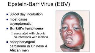 EBV notes | PDF