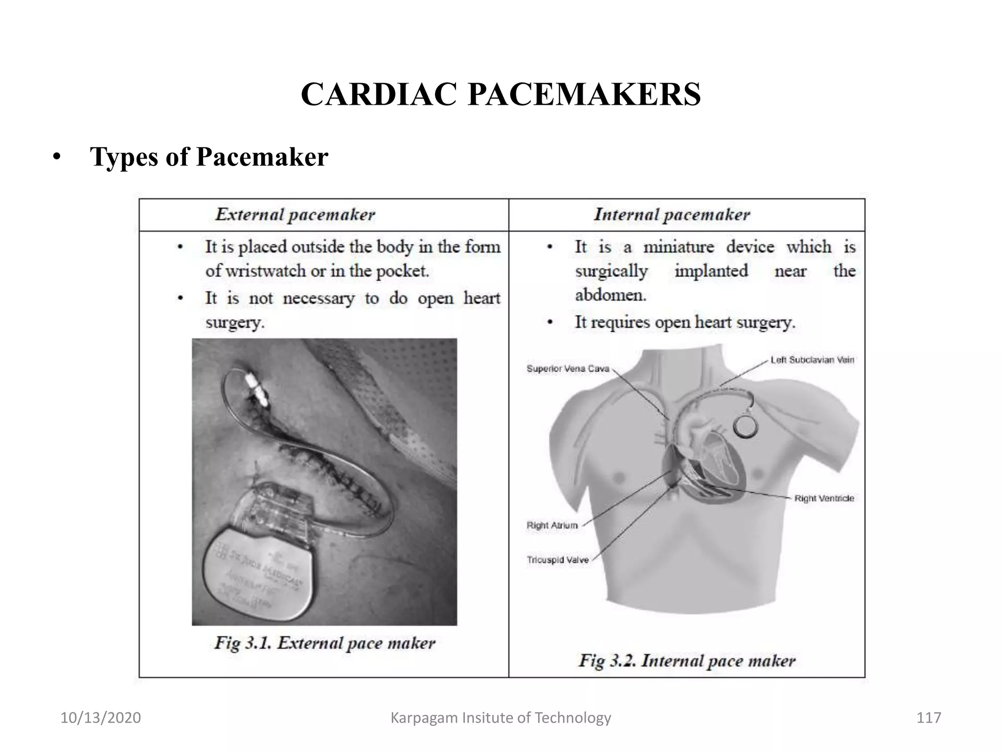 CARDIAC PACEMAKERS
• Types of Pacemaker
10/13/2020 Karpagam Insitute of Technology 117
 