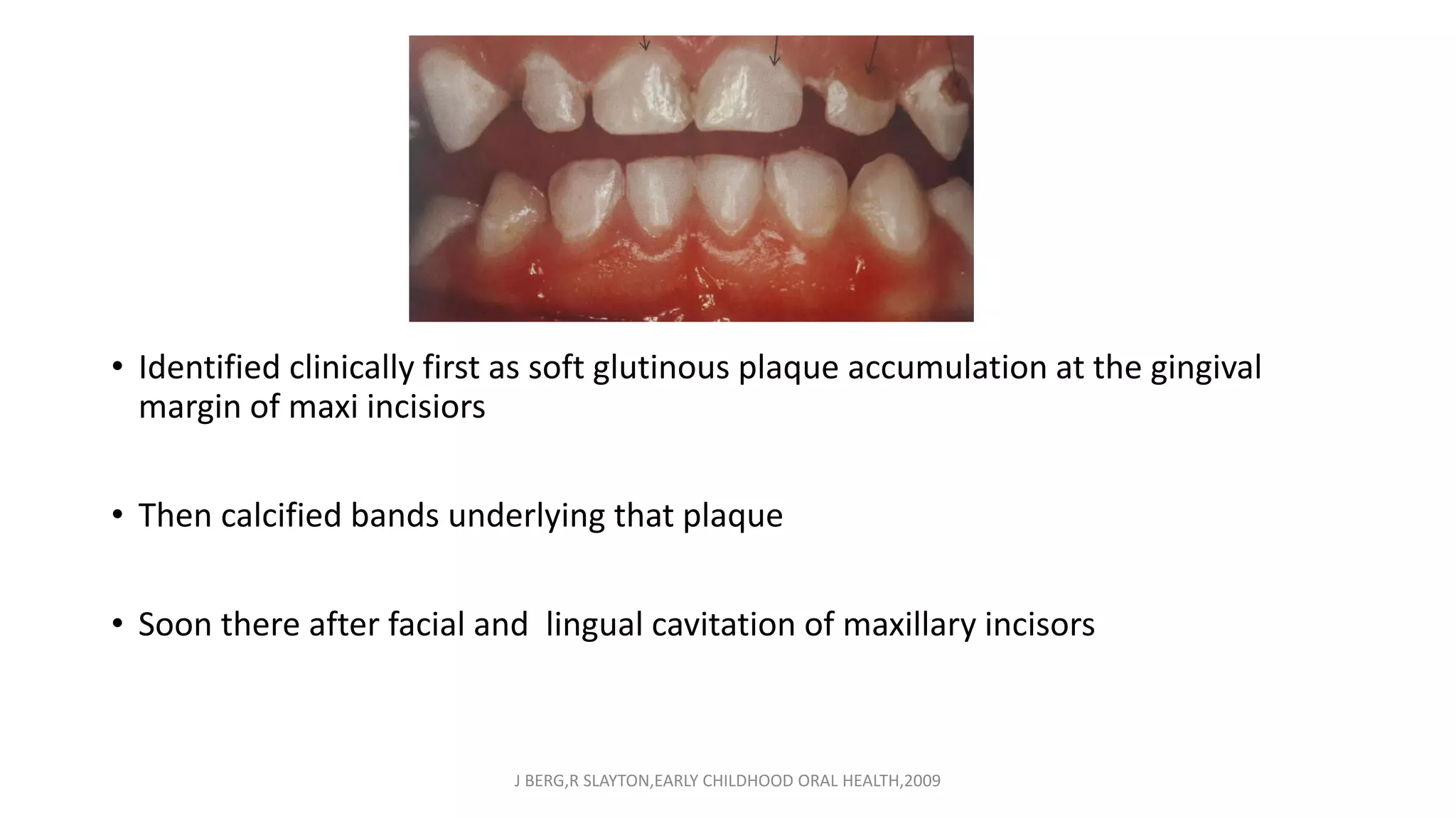 • Identified clinically first as soft glutinous plaque accumulation at the gingival
margin of maxi incisiors
• Then calcified bands underlying that plaque
• Soon there after facial and lingual cavitation of maxillary incisors
J BERG,R SLAYTON,EARLY CHILDHOOD ORAL HEALTH,2009
 