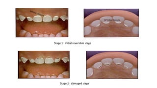 Stage 1 : initial reversible stage
Stage 2 : damaged stage
 