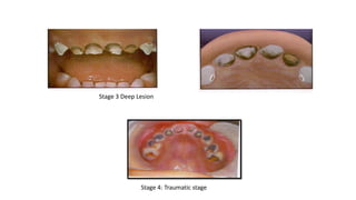 Stage 3 Deep Lesion
Stage 4: Traumatic stage
 
