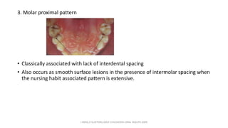 3. Molar proximal pattern
• Classically associated with lack of interdental spacing
• Also occurs as smooth surface lesions in the presence of intermolar spacing when
the nursing habit associated pattern is extensive.
J BERG,R SLAYTON,EARLY CHILDHOOD ORAL HEALTH,2009
 