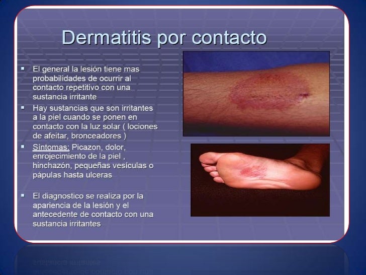 Como beber el escaramujo a la psoriasis