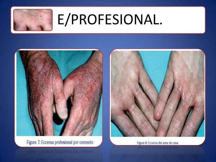 El ungüento al tratamiento atopicheskogo de la dermatitis