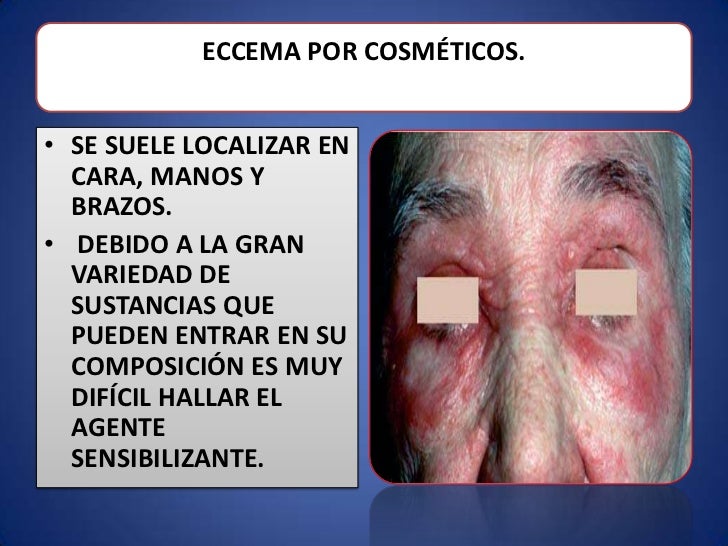 La fotoquimioterapia a la psoriasis el precio