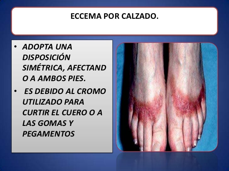 El niño 1 año que dar de comer a atopicheskom la dermatitis
