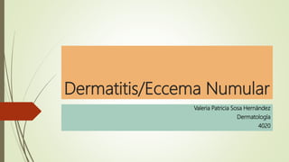 Dermatitis/Eccema Numular
Valeria Patricia Sosa Hernández
Dermatología
4020
 
