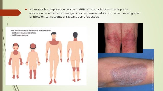 Como curar effectivamente la psoriasis por los medios públicos