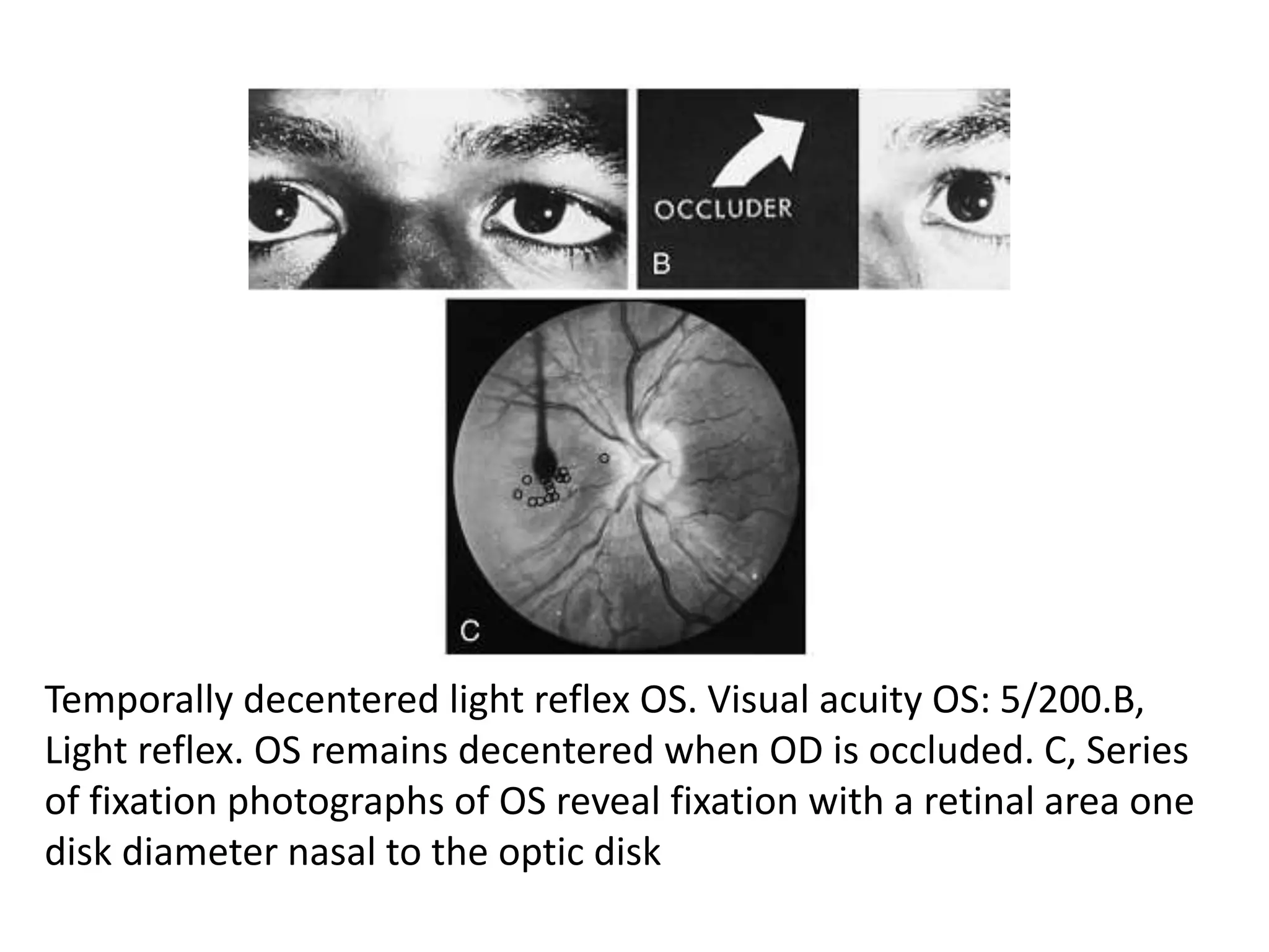 Temporally decentered light reflex OS. Visual acuity OS: 5/200.B,
Light reflex. OS remains decentered when OD is occluded. C, Series
of fixation photographs of OS reveal fixation with a retinal area one
disk diameter nasal to the optic disk
 
