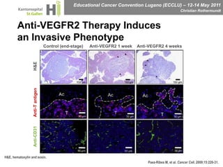 Anti-VEGFR2 Therapy Induces an Invasive PhenotypeControl (end-stage)Anti-VEGFR2 1 weekAnti-VEGFR2 4 weeksH&EAnti-T antigenAnti-CD31H&E, hematoxylin and eosin.Paez-Ribes M, et al. Cancer Cell. 2009;15:220-31.
