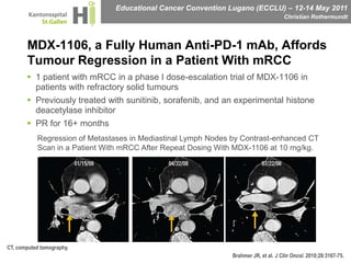 MDX-1106, a Fully Human Anti-PD-1 mAb, Affords Tumour Regression in a Patient With mRCC1 patient with mRCC in a phase I dose-escalation trial of MDX-1106 in patients with refractory solid tumoursPreviously treated with sunitinib, sorafenib, and an experimental histone deacetylase inhibitorPR for 16+ monthsRegression of Metastases in Mediastinal Lymph Nodes by Contrast-enhanced CT Scan in a Patient With mRCC After Repeat Dosing With MDX-1106 at 10 mg/kg.CT, computed tomography.Brahmer JR, et al. J Clin Oncol. 2010;28:3167-75.