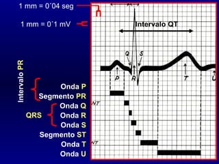 Onda  P Segmento  PR Onda  Q Onda  R Onda  S Segmento  ST Onda  T Onda  U Intervalo QT Intervalo  PR QRS 1 mm = 0´1 mV 1 mm = 0´04 seg 