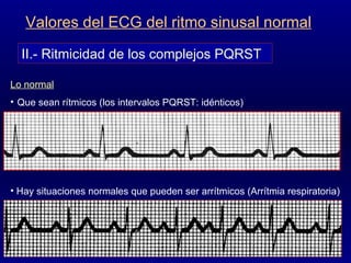 Valores del ECG del ritmo sinusal normal II.- Ritmicidad de los complejos PQRST Lo normal Que sean rítmicos (los intervalos PQRST: idénticos) Hay situaciones normales que pueden ser arrítmicos (Arrítmia respiratoria) 