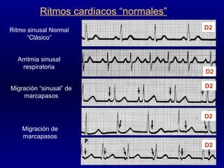 Ritmo sinusal Normal “Clásico” Arritmia sinusal respiratoria Migración “sinusal” de marcapasos Migración de marcapasos Ritmos cardiacos “normales” D2 D2 D2 D2 D2 
