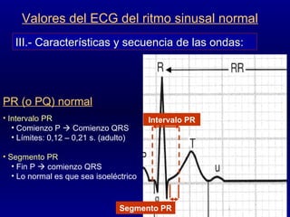 III.- Características y secuencia de las ondas: Valores del ECG del ritmo sinusal normal PR (o PQ) normal Intervalo PR Comienzo P    Comienzo QRS Límites: 0,12 – 0,21 s. (adulto) Segmento PR Fin P    comienzo QRS Lo normal es que sea isoeléctrico Intervalo PR Segmento PR 