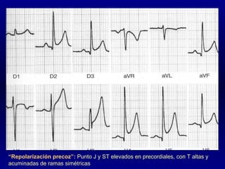 “ Repolarización precoz”:  Punto J y ST elevados en precordiales, con T altas y acuminadas de ramas simétricas 