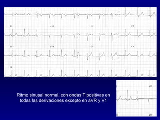 Ritmo sinusal normal, con ondas T positivas en todas las derivaciones excepto en aVR y V1 