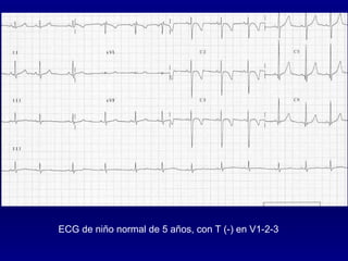ECG de niño normal de 5 años, con T (-) en V1-2-3 