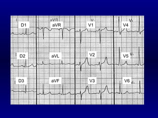 V1 V2 V3 V4 V5 V6 D1 D2 D3 aVR aVL aVF 
