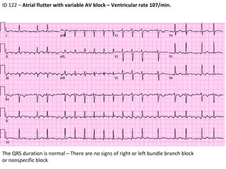 ECG #10 - ID122 - Atrial Flutter | PPT