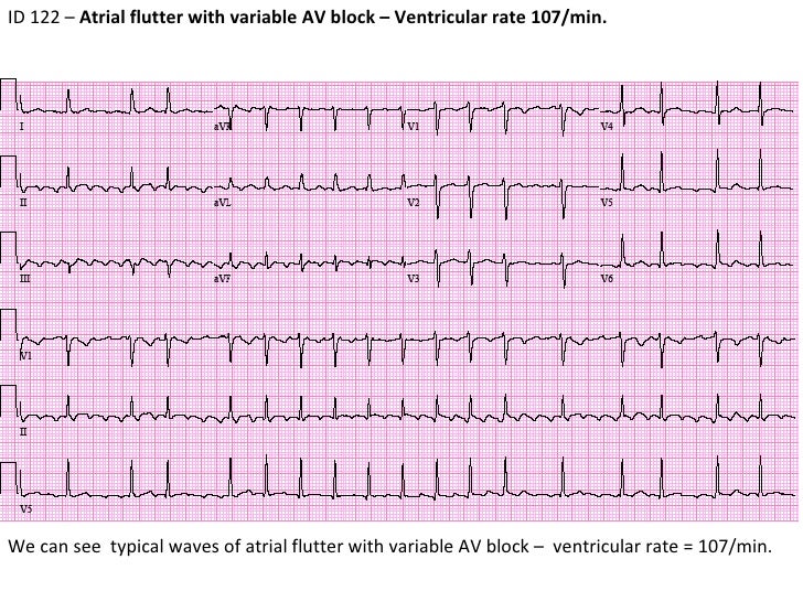a flutter ekg a flutter ekg