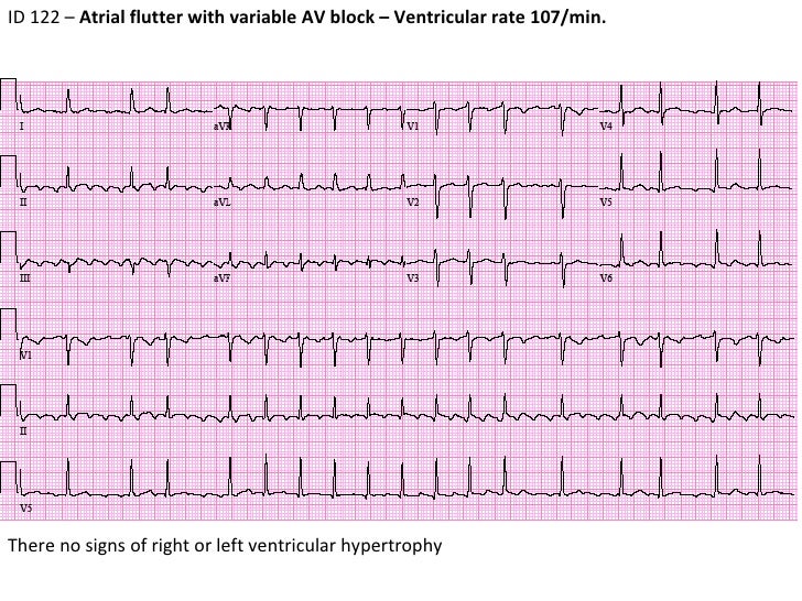 ECG #10 - ID122 - Atrial Flutter