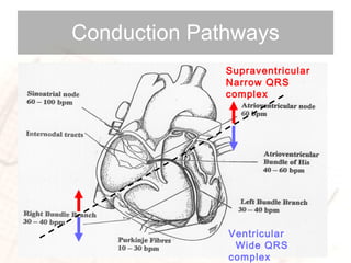 Conduction Pathways Supraventricular  Narrow QRS complex Ventricular  Wide QRS complex 