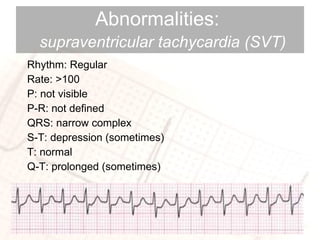 Abnormalities:    supraventricular tachycardia (SVT) Rhythm: Regular Rate: >100 P: not visible P-R: not defined QRS: narrow complex S-T: depression (sometimes) T: normal Q-T: prolonged (sometimes) 