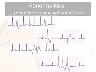 Abnormalities:    premature ventricular complexes 